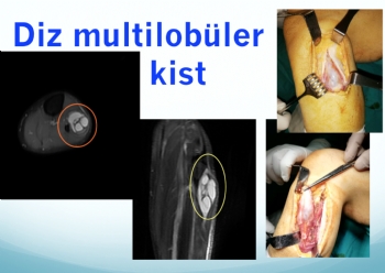 diz multilobiler ganglion kisti 