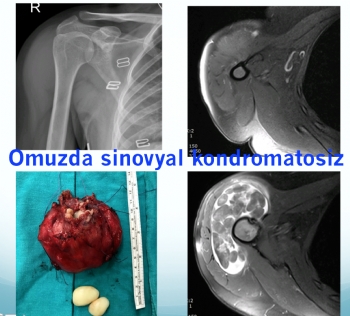 shoulder synovial chondromatosis