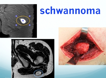 kalça bölgesinde scwannoma 