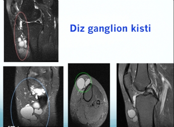 diz bölgesi ganglion kisti 