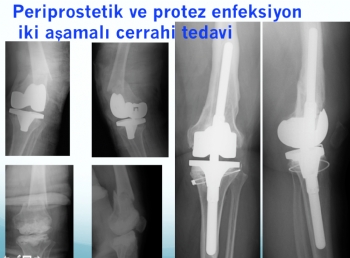 periprostetik kırık ve enfeksiyon iki aşamalı tedavi