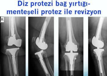diz protezi bağ yetmezliği - menteşeli protez revizyonu