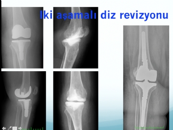 diz protezi  iki aşamalı revizyon (septik-enfeksiyona bağlı gevşeme )