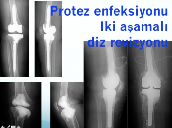 diz protezi  iki aşamalı revizyon (septik-enfeksiyona bağlı gevşeme )